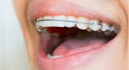 Dùng hàm duy trì sau niềng răng – Những lợi ích bạn không ngờ tới
