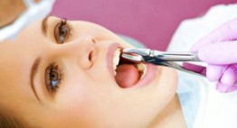 Nhổ răng khi niềng răng và những điều nhất định bạn phải biết
