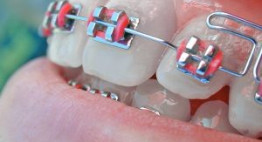 Giải đáp vấn đề : Liệu rằng niềng răng có hại cho sức khỏe không?