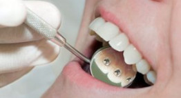 Giúp bạn biết rõ hơn về quy trình niềng răng cho kết quả như ý