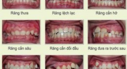 Nẹp răng thẩm mỹ – Xu hướng làm đẹp răng được ưa chuộng tại Việt Nam