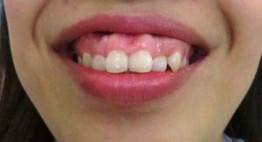 Niềng răng hô với chuyên gia 15 năm kinh nghiệm – Hiệu quả, an toàn cao