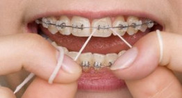 Bạn đã biết niềng răng đẹp cỡ nào chưa?