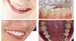 Giải pháp niềng răng nhanh – Hiệu quả – an toàn cho răng đều đẹp như ý