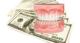Chi phí 1 lần niềng răng được tính như thế nào?