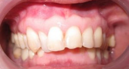 Điều gì sẽ cho bạn biết bị răng hô có xấu không?
