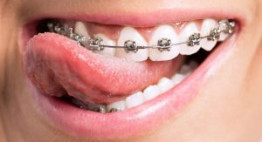 Những điều cần biết khi niềng răng giúp bạn có được kết quả như ý