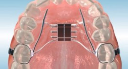 Nong hàm trong khi niềng răng dành cho đối tượng nào và có hiệu quả không?