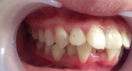 Niềng răng bị lệch – giải pháp hiệu quả nhất để sở hữu hàm răng đều đẹp