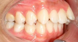 Răng bị hô: Nên phẫu thuật hàm hô hay niềng răng?