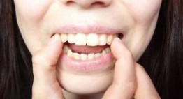 Răng hô là gì và làm sao để khắc phục tình trạng này?