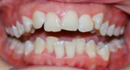 Răng mọc sai vị trí – Nguyên nhân, hậu quả và giải pháp
