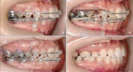Niềng răng – Cách làm răng đều đẹp mà không làm tổn hại răng thật