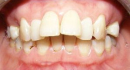 Chỉnh răng hô giá bao nhiêu tiền khi áp dụng phương pháp niềng răng?