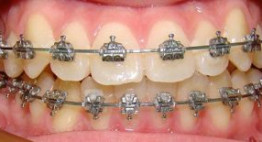 “Mổ xẻ” kiến thức về phương pháp niềng răng bằng mắc cài