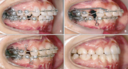Nhận biết răng hô và cách chỉnh răng hô thẩm mỹ hiệu quả nhất