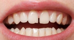 Răng thưa có xấu không & làm cách nào để răng khít sát tự nhiên?