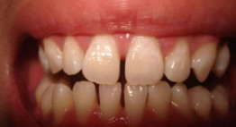 Răng thưa và cách khắc phục hiệu quả bằng phương pháp chỉnh nha