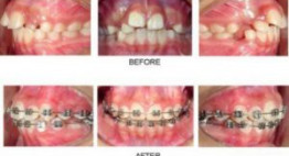 Nguyên nhân răng bị hô & Cách điều trị triệt để đến 90% tình trạng hô