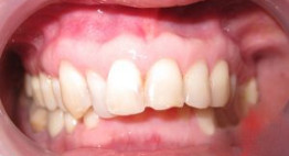 Răng hô làm sao hết? – Bí mật hàm răng đều đẹp đến từ đâu?