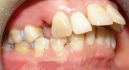 “Điểm mặt” các nguyên nhân gây răng vẩu & giải pháp khắc phục