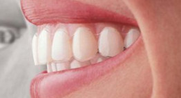 Niềng răng không mắc cài Clear Aligner – NÊN HAY KHÔNG?