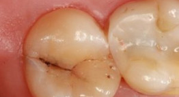 Ngay tại bài viết này bạn sẽ biết răng sâu có niềng được không?