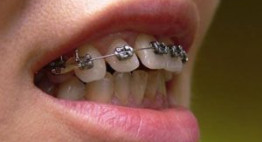 Răng vẩu – Nguyên nhân, phân loại và cách nắn chỉnh răng vẩu hiệu quả