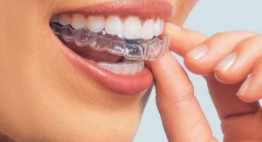 Cách niềng răng tại nhà HIỆU QUẢ cho mọi hàm răng lệch lạc