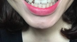 Răng khểnh đẹp hay xấu? – Nên giữ lại hay nhổ bỏ răng khểnh?
