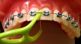 Dùng chỉ nha khoa khi niềng răng đúng chuẩn – Bạn đã biết chưa?