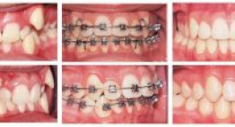 Bất ngờ trước sự thay đổi của răng trong các giai đoạn niềng răng