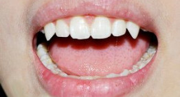 Răng khểnh có ý nghĩa gì quan trọng không?