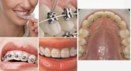 Các kiểu niềng răng thẩm mỹ – Đặc điểm & chi phí cụ thể