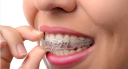 Niềng răng – Phương pháp khắc phục hàm răng nhiều khiếm khuyết