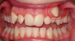 Răng khểnh mọc quá cao phải xử lý như thế nào?