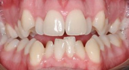 Răng mọc chen chúc – Nguyên nhân, ảnh hưởng & giải pháp khắc phục