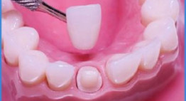 [ TƯ VẤN TỪ CHUYÊN GIA] Bọc răng sứ có niềng răng được không?