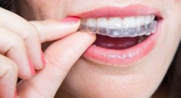 Chỉnh nha không mắc cài – Phương pháp niềng răng như không niềng