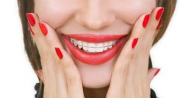 5 lưu ý “vàng” cần biết khi sử dụng hàm duy trì sau niềng răng