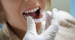 Niềng răng bằng nhựa – Máng niềng răng tiện lợi, thoải mái, kết quả cao