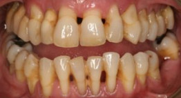 Nếu không muốn niềng răng bị tụt lợi >>> Tham khảo ngay những chia sẻ của chuyên gia
