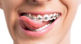 Niềng răng cố định – Đa dạng loại hình mắc cài, hiệu quả, thẩm mỹ
