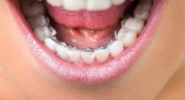 Chỉ niềng răng hàm dưới liệu có mang đến kết quả chỉnh nha tốt không?