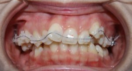 Niềng răng- Phương án thẩm mỹ răng “ĐƯỢC LÒNG” khách hàng Việt