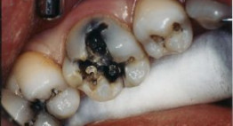 Chữa răng sâu mất bao nhiêu tiền theo từng mức độ hư hỏng của răng?