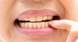 Cách lấy cao răng tại nhà đơn giản khiến cao răng cũng phải bong ra