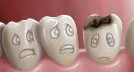 Lý do ngừa sâu răng ngay bây giờ nếu không muốn hàm răng biến mất dần