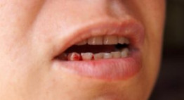 Nhổ răng bị chảy máu & những lưu ý quan trọng luôn phải nắm rõ