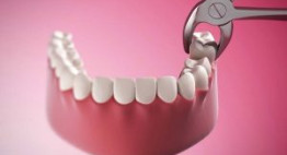 Nhổ răng ở đâu tốt, không đau và đảm bảo an toàn cao?